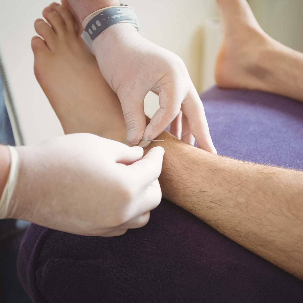 physiotherapist-performing-dry-needling-leg-patient-square