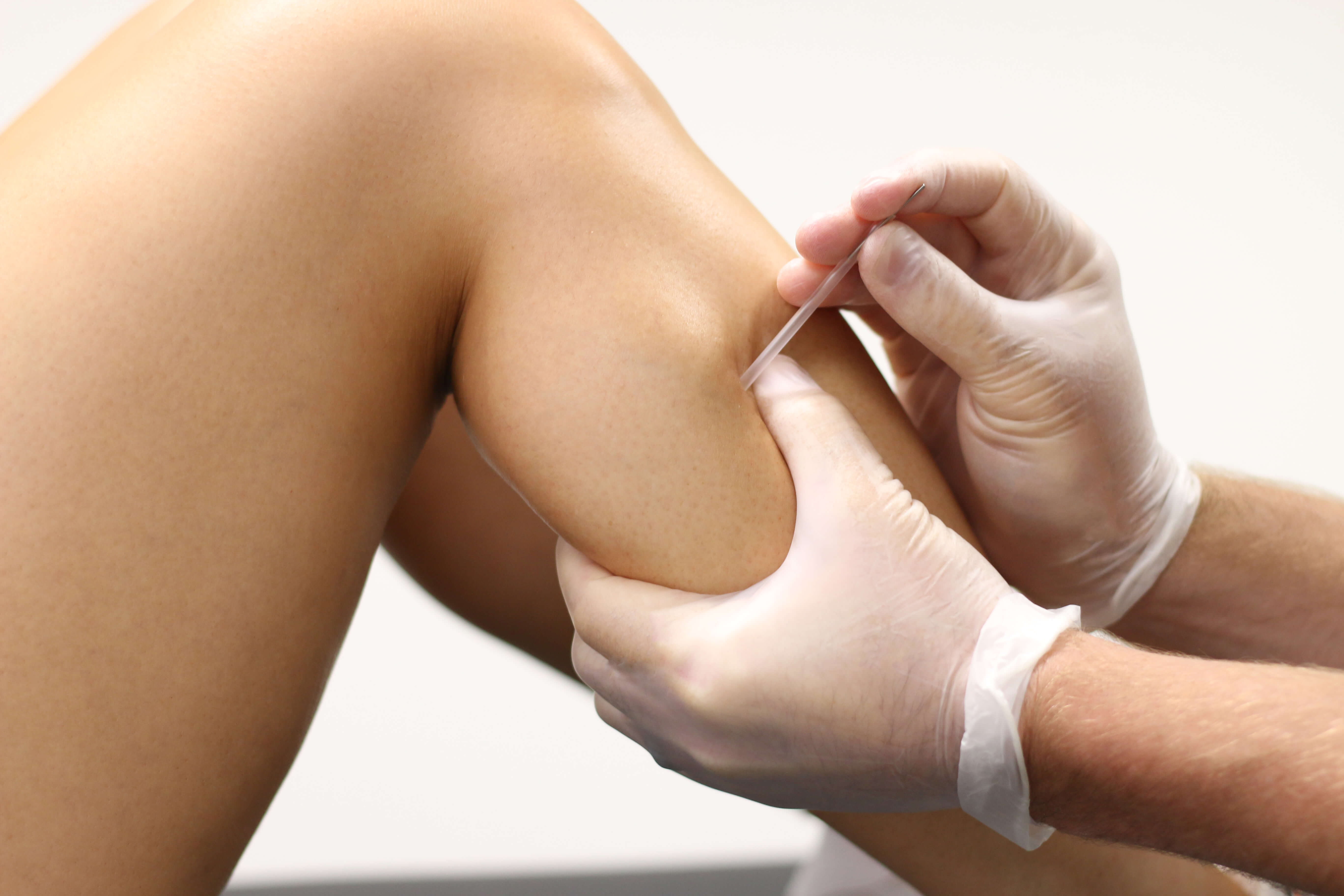 dry needling treatment at Renew Wellness dry needling treatment at Renew Wellness