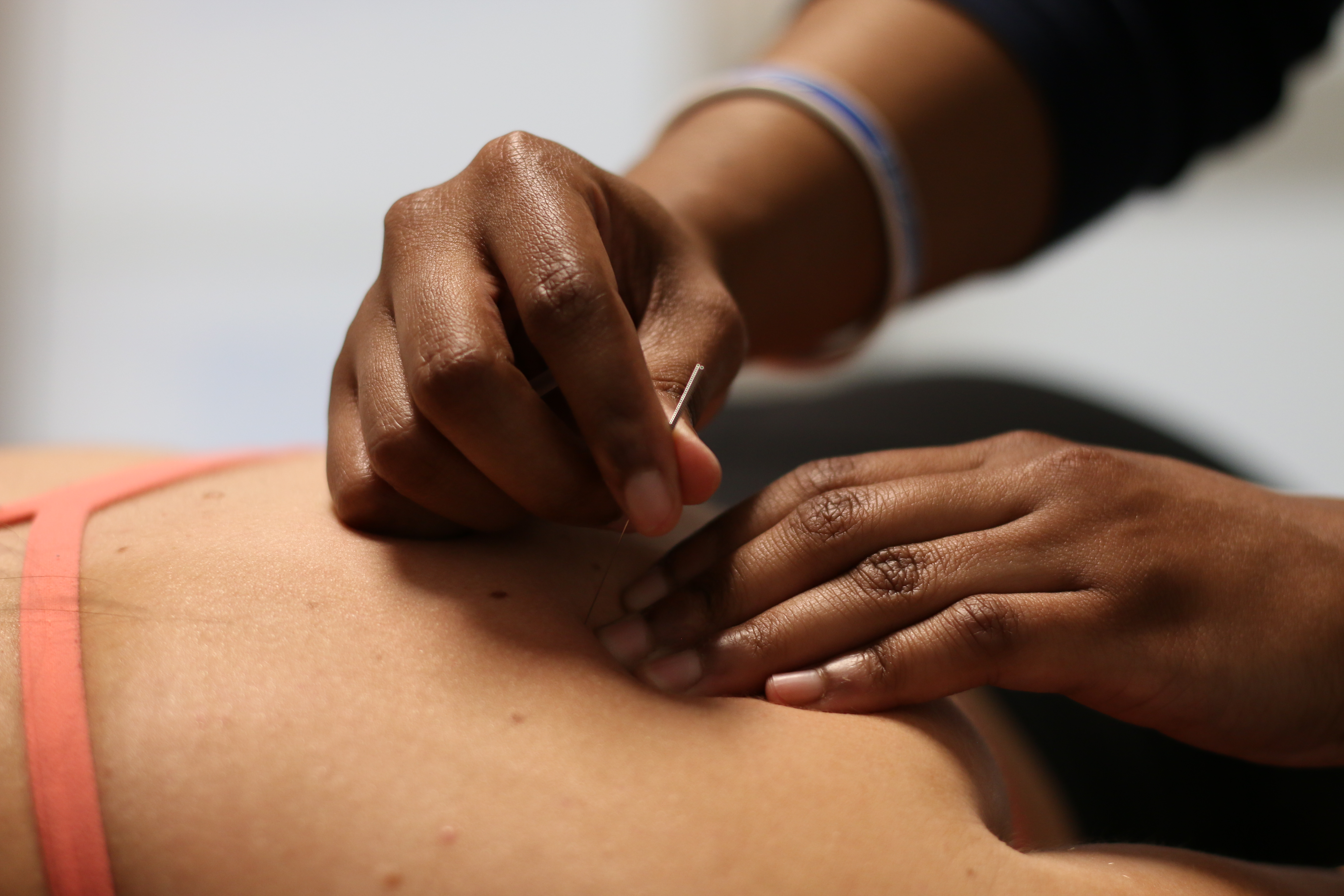 Dry Needling Treatment at Renew Wellness