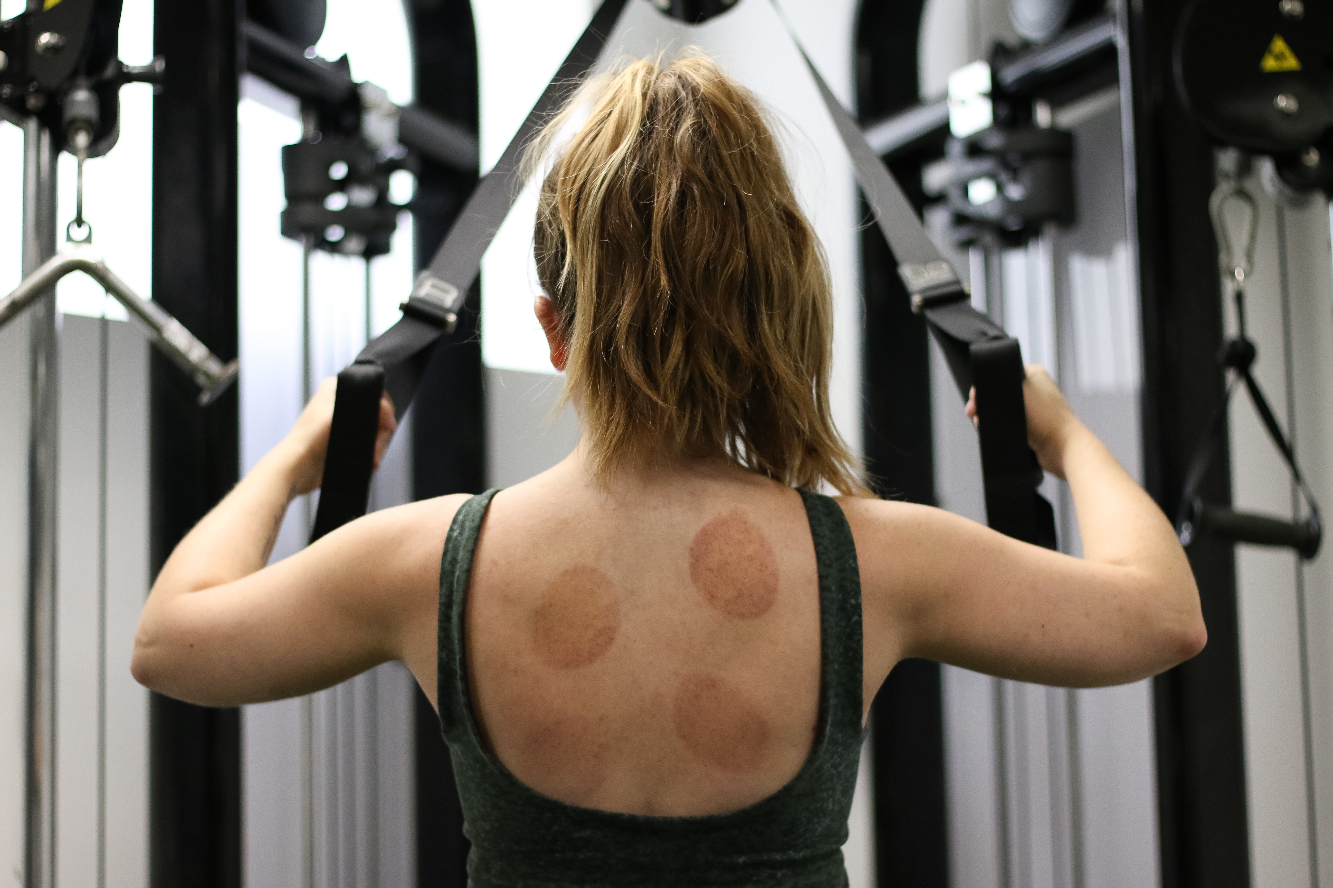 Cupping Marks on the Back